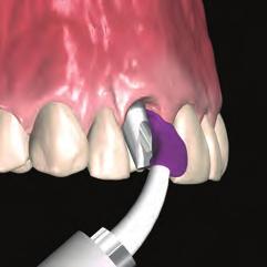 dental stone with soft tissue replication material Remove the
