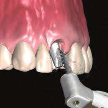 25mmD Hex Tool Attach the Angled Abutment to the Implant Analog in