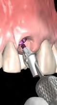 the provisional restoration Common procedures for abutment