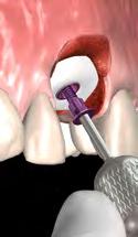 Option 1: Attaching an Angled Abutment and chairside procedures for