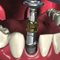 surgery features a concave transgingival profile which matches the
