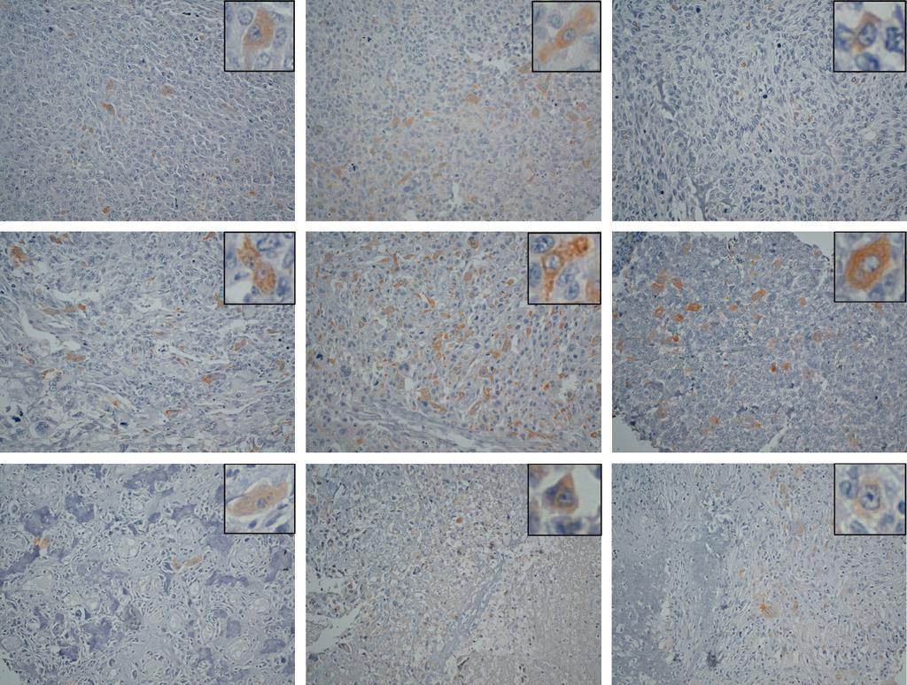 IDH2 Mutation in Osteosarcoma X. Liu et al. A B C D E F G H I Figure 4. Immunohistochemical analysis by MsMab-1 against tissue microarray of osteosarcomas.