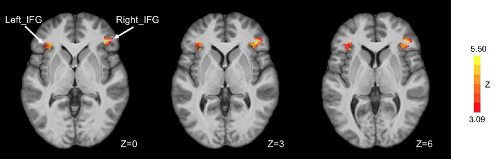 Cognitive Behavioral Therapy Improves Prefrontal Cortex