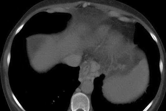 paraumbilical vein Gallbladder wall edema often seen and