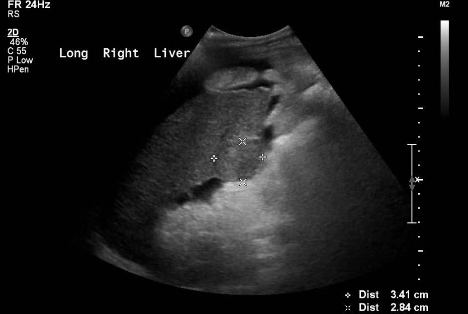 Ultrasound for HCC Screening Goal: detect HCC at early stage when amenable to curative