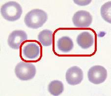 *anemia( 贫血 ): is defined clinically as a