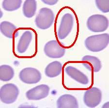 hemoglobin in the blood. RBC <3.