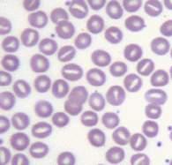 spherocytosis ( 遗传性球形红细胞血症 ) Hereditary