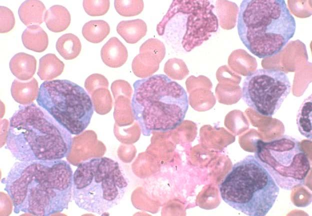 Leukemia commonly known as the blood cancer.