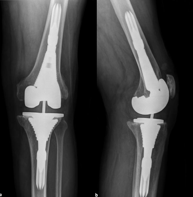 Revision Total Knee Arthroplasty Using Metaphyseal Sleeves at Short-term Follow-up Ronald Huang, MD; Gustavo Barrazueta, BS; Alvin Ong, MD; Fabio Orozco, MD; Mehdi Jafari, MD; Catelyn Coyle, BS;
