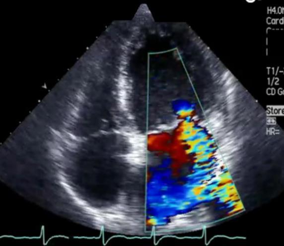 infiltration Aortic and mitral valve