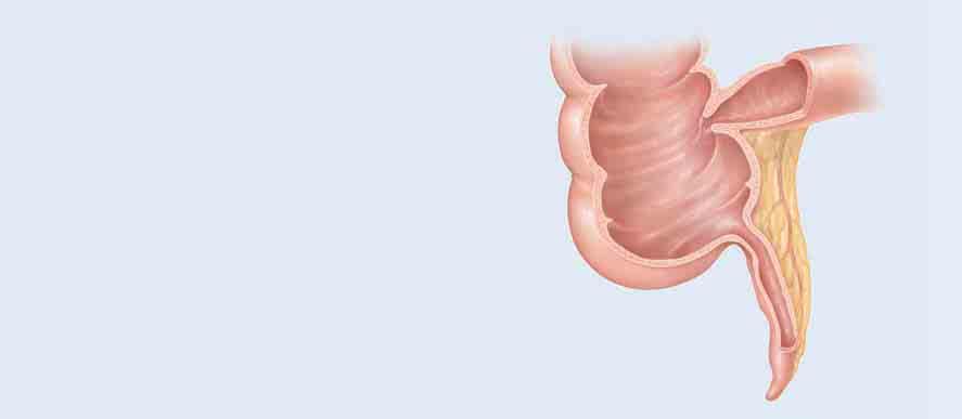 A Normal Appendix The small intestine brings liquid waste to the colon and
