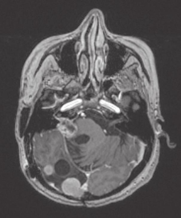 Bez kontrasta lezija je izodenzna s mozgovnim parenhimom, a kalcifikacije su rijetke. Uz i.v. kontrast većina neliječenih tumora homogeno se boje.