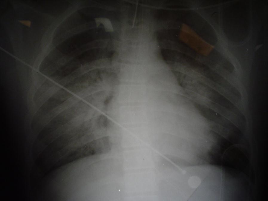 Case 3 Primary Blast Injury with Air Embolism and? Intestinal injury 14 yo boy admitted in shock, unconscious with ph 7.