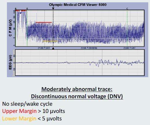 Upper border of trace >10µV and lower border of trace >5µV Fig B: Shows a normal background activity with