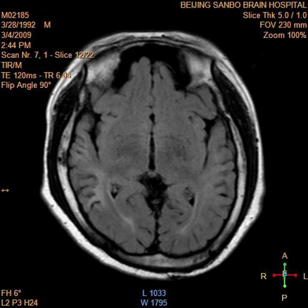 Fig. 5: Axial Flair: watershed area of bilateral temporal lobes and ccipital-parietal lobes involved with