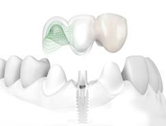 Implant Therapy - a patient oriented