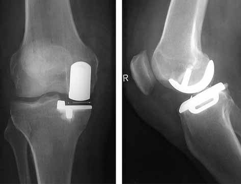UNICOMPARTMENTAL KNEE ARTHROPLASTY 711 The mean age of the patients was 66 years (range : 45 to 90). The mean weight was 84.2 kg (range : 53 to 115) with a mean BMI (kg/m 2 ) of 27.5. Mean follow-up was 3.