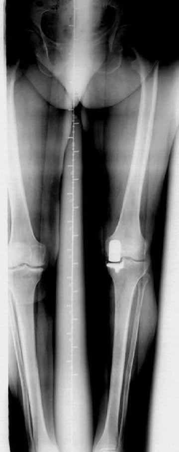 UNICOMPARTMENTAL KNEE ARTHROPLASTY 713 DISCUSSION Fig. 4. Adequate undercorrection of femorotibial alignment. The knee functioned well afterwards.