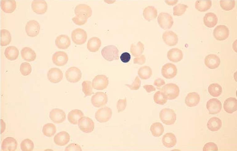 Case #1 Peripheral film: increased polychromasia; 4-10 schistocytes / hpf