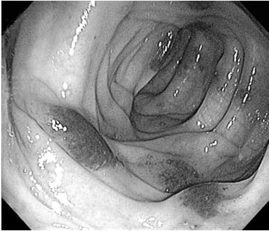 Colitis and Enteritis Colonoscopy and Histopathology Findings Colonoscopy Multifocal circumscribed erythematous lesions Histopathology Predominantly chronic inflammation Eosinophils and focal active