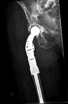 reconstruction of the proximal femur with a cemented modular revision prosthesis (Link