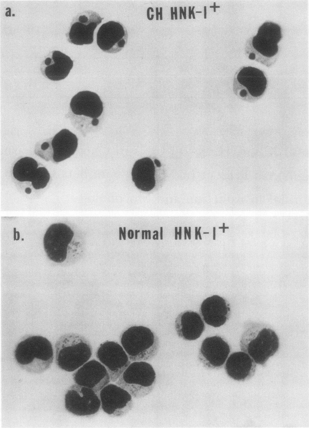 a. CH HNK-l+ b. HNIK-I+ FIGURE 1 Characteristic large granule in NK cells from a CH patient.