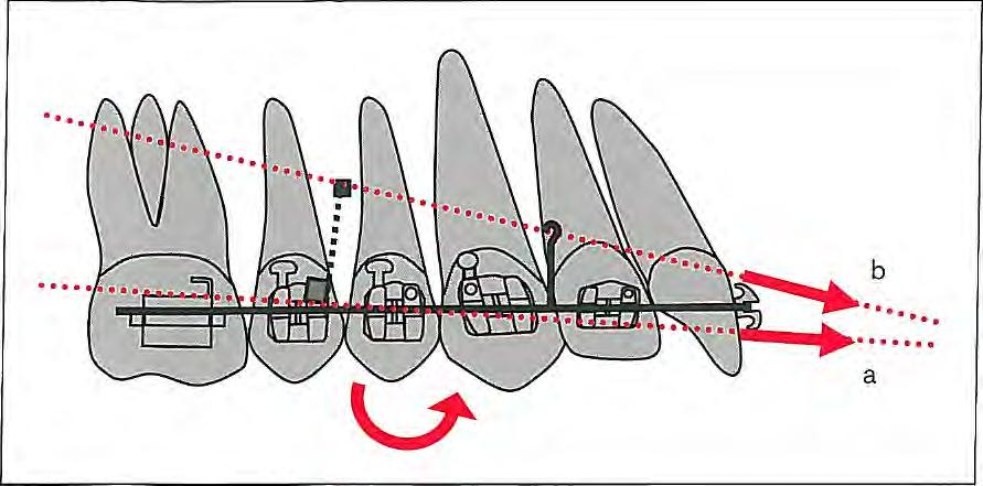 5 I Anchorage Control Fig 5-19 In reverse headgear applications, if the line of action of the force passes below the center of resistance of the upper dental arch (a), it causes counterclockwise