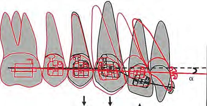 However, the maxillary occlusal plane inclination may not be fully corrected because the canines and premolars erupt as the incisors intrude and flare.