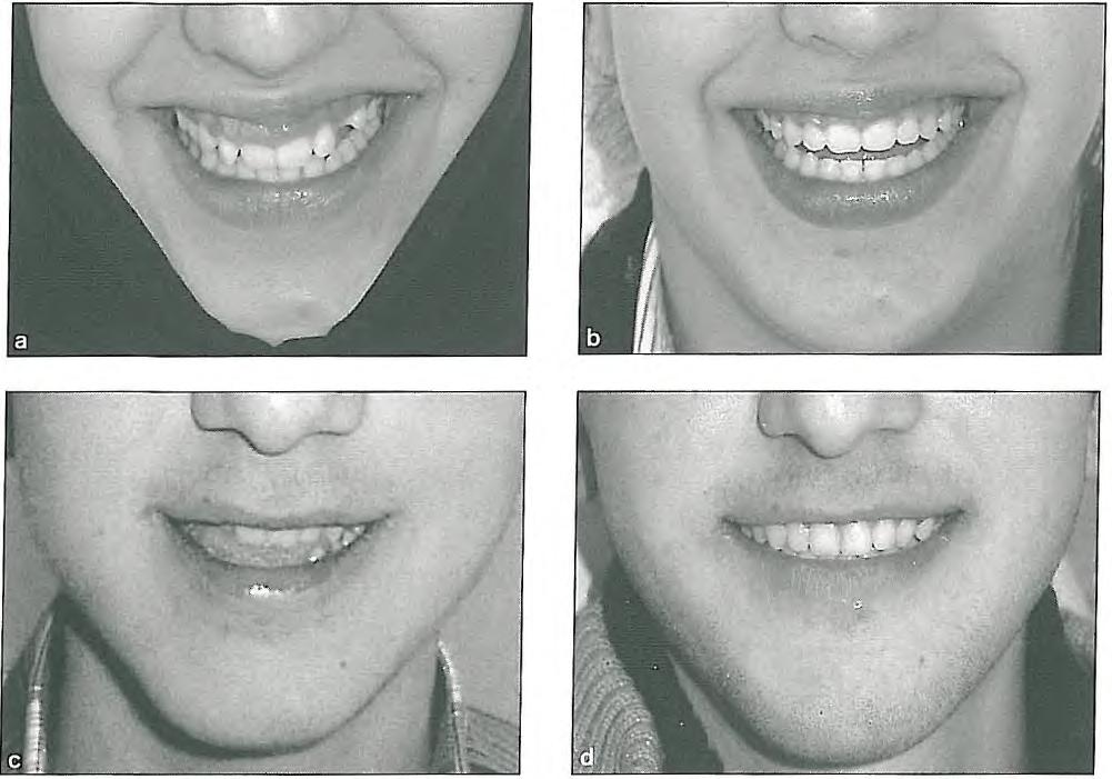 6 Correction of Vertical Discrepancies Fig 6-4 Changes in smile lines due to orthodontic treatment of a patient with a gummy smile (a and 0 and a patient with a high smile line (c and O.