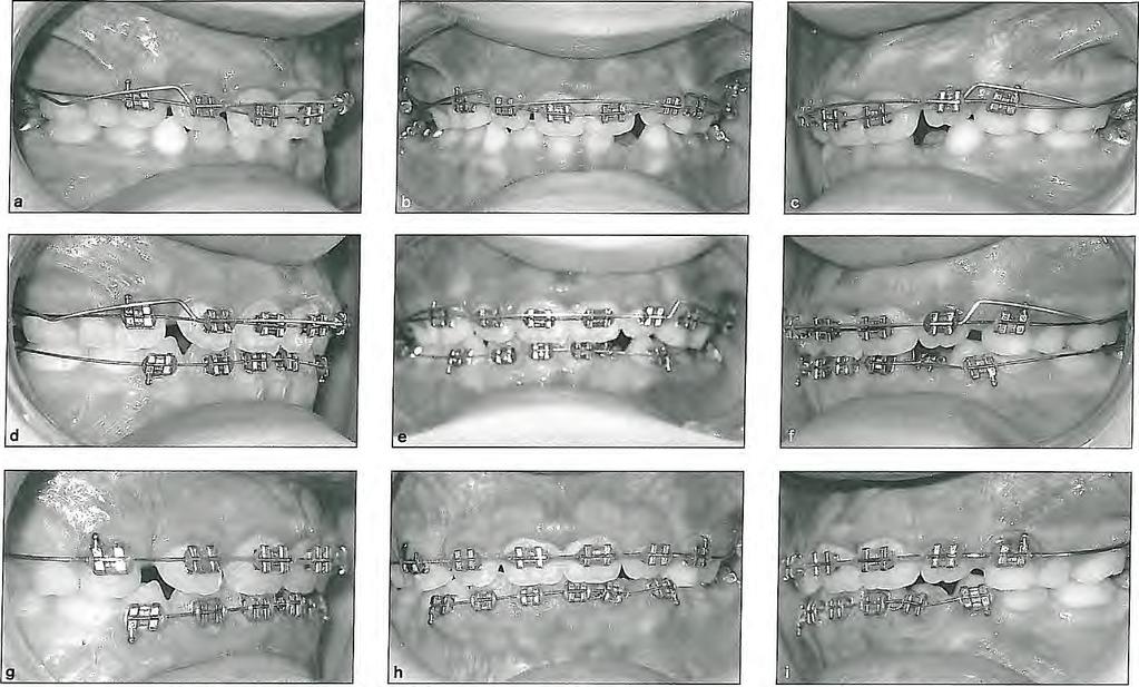 6 l Correction of Vertical Discrepancies Fig 6-11 Correction of deep bite can be accomplished with a 0.01 4-inch NiTi wire combined with a continuous intrusion arch. (a to c) Beginning of treatment.