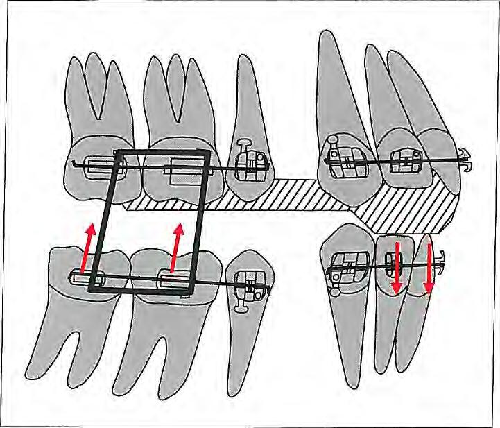 6 I Correction of Vertical Discrepancies Fig 6-15 Deep bite correction by selective molar extrusion.