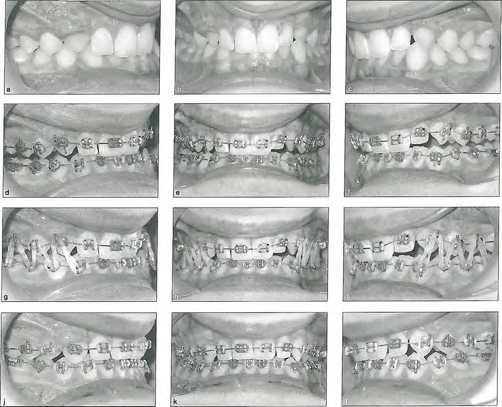 Deep Bite Correction Fig 6-16 Deep bite correction with selective mo ar extrusion mechanics. (a to c) Before treatment.