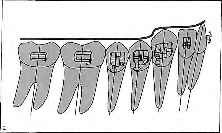 Intrusion of the incisors and canines, or extrusion of the molars only, might eliminate the problem.