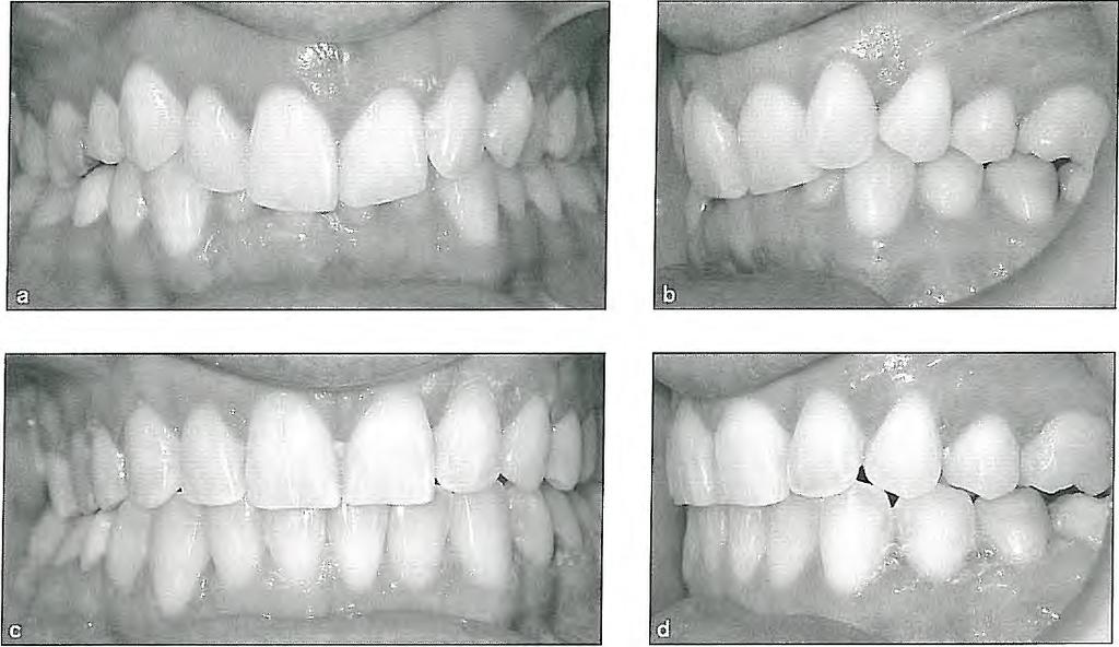 Fig 6-19 (a and b) Deep bite case in which a reverse-curved wire is indicated. (c and d) Alignment has been done with maxillary incisor protrusion and intrusion as well as premolar extrusion.