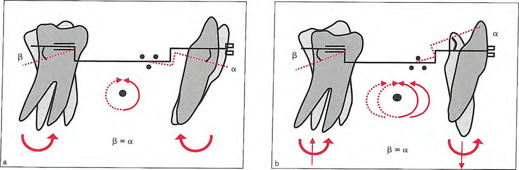 6 Correction of Vertical Discrepancies Fig 6-25 The sections of the (maxillary) utility arch: anterior section ( A), anterior step (B), buccal bridge (C), posterior step (D), and posterior section