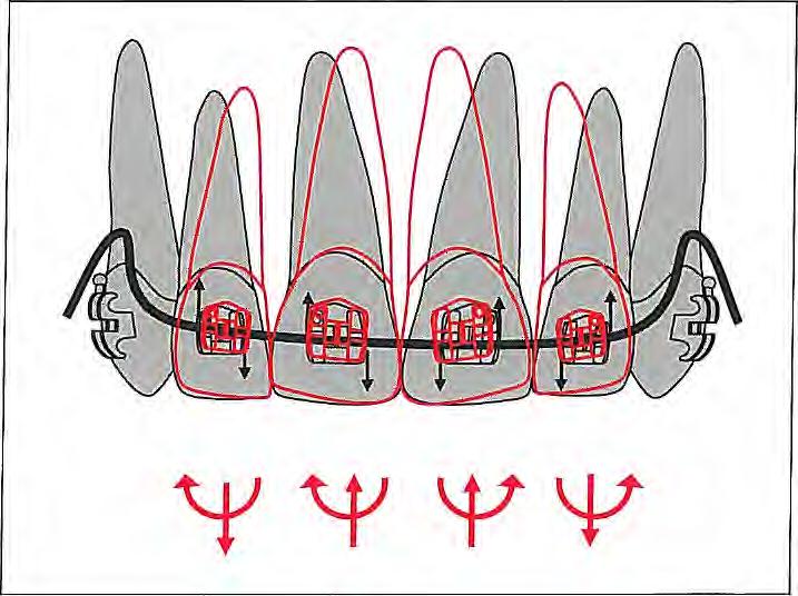 Deep Bite Correction Fig 6-28 If a 2 x 4 archwire is engaged directly in the incisor brackets, the roots tend to move toward the midline.