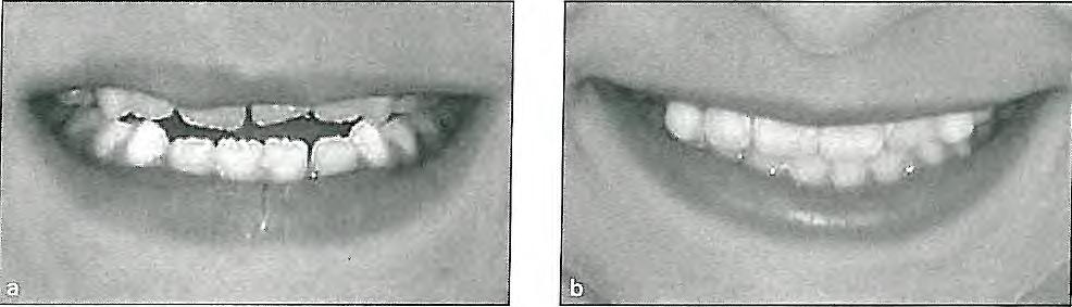 Fig 6-29 The smile line is affected by the cant of the occlusal plane. This patient's high smile line (a) needed to be restored with maxillary incisor extrusion (b).