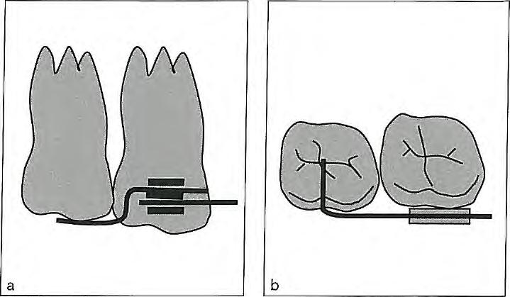 Fig 6-36 (a and b) In open bite cases, erupting second molars can be controlled using a 0.016 x 0.022 inch SS segmented arch that passes through the auxiliary tube of the first molar.