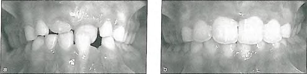 7 I Correction of Transverse Discrepancies Fig 7-1 (a) Traumatic occlusion due to anterior crossbite in the transitional dentition. (b) The problem was corrected easily using a removable appliance.