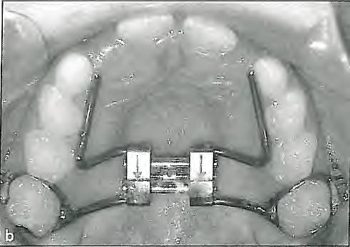 As expansion progresses, a large median diastema appears, indicating opening of the suture. This diastema closes spontaneously with the pull of the transseptal fibers.
