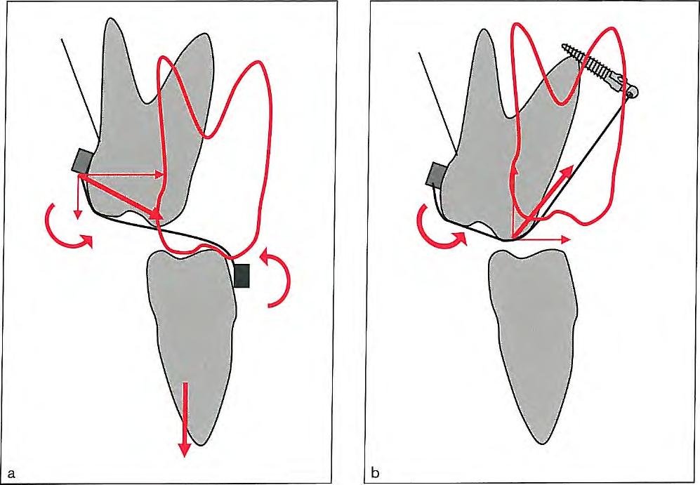 Scissors Bite Correction Fig 7-6 Crossbite elastics can be used to correct posterior crossbite. (a) The extrusive effect of the elastic must be considered when treating high-angle patients.