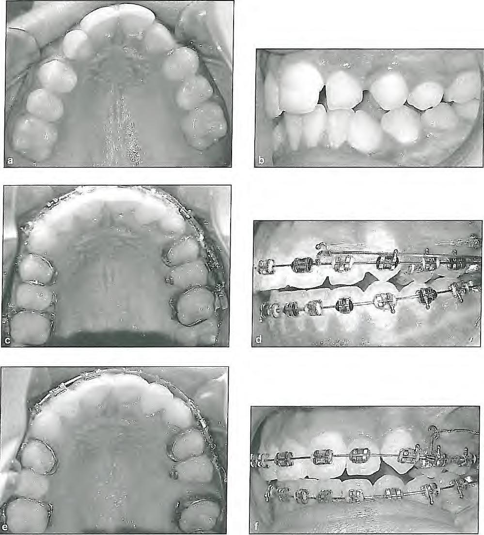 8 I Correction of Anteroposterior Discrepancies Fig 8-1 Microimplant anchorage mechanics for molar distalization. (a and h) Before treatment.