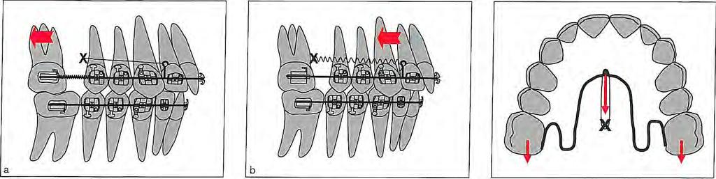 Molar Distalization Fig 8-3 Molars can be distalized by taking support from the TAD inserted into the mid- palatal suture.