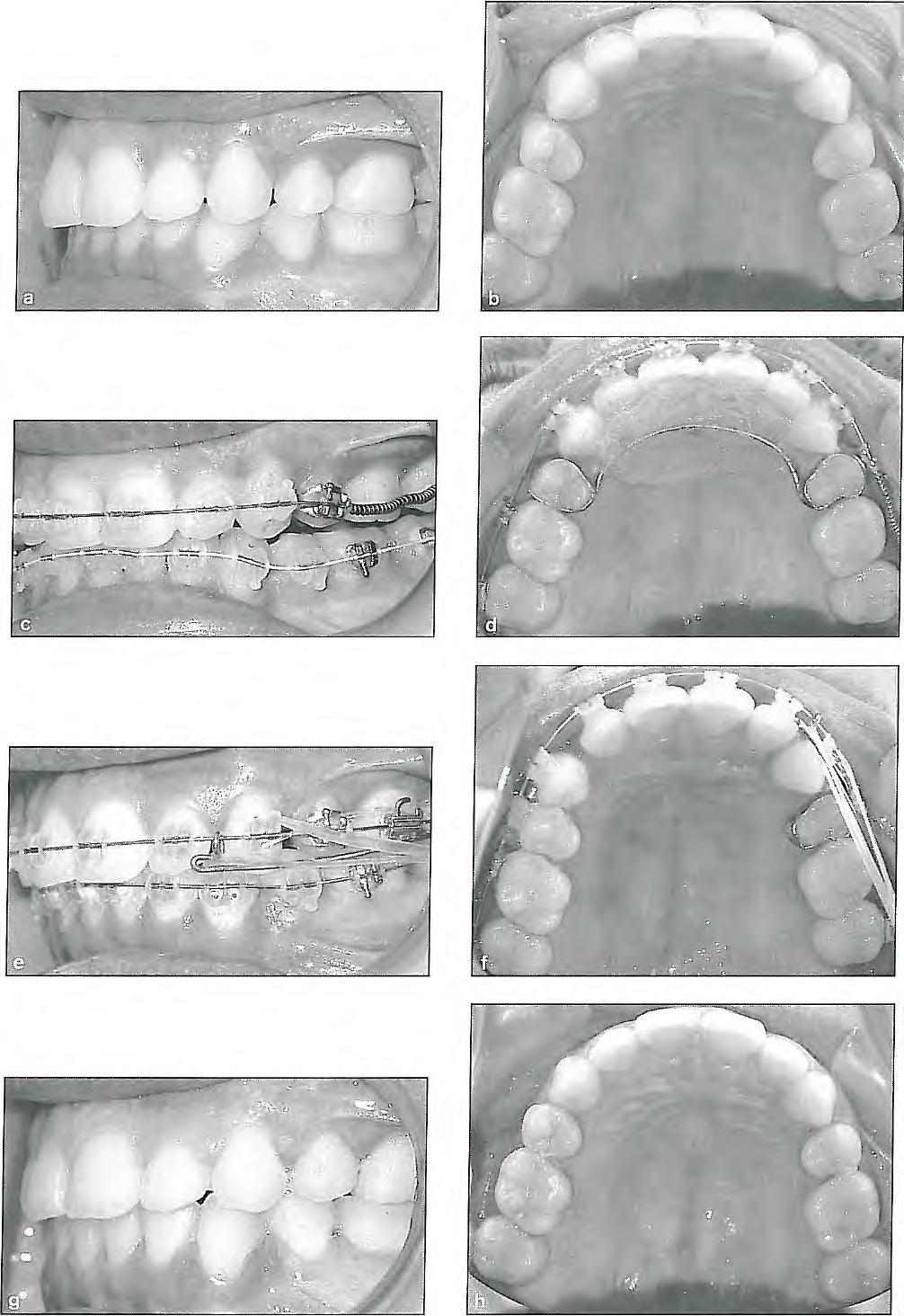 Molar Distalization Fig 8-6 (a and b) Before unilateral molar distalization, (c and d) Nance and NiTi coil spring. (e and f) Sliding jig, chain, and Class II elastics combination.