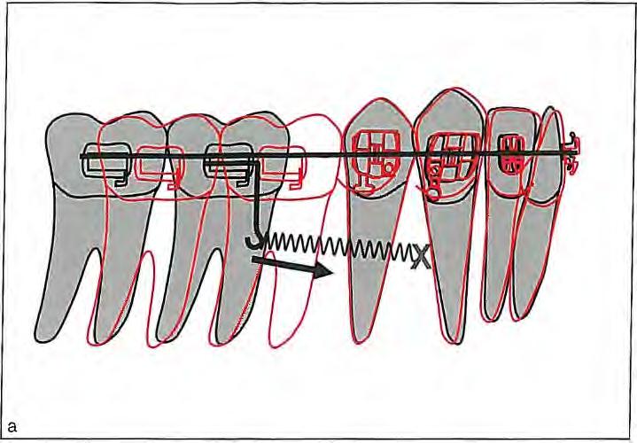 (b) In addition to buccal force, a light force should be applied on the lingual aspect to prevent molar rotation, Uprighting Mesially Tipped Molars If the mesial contact breaks, molars tend to tip