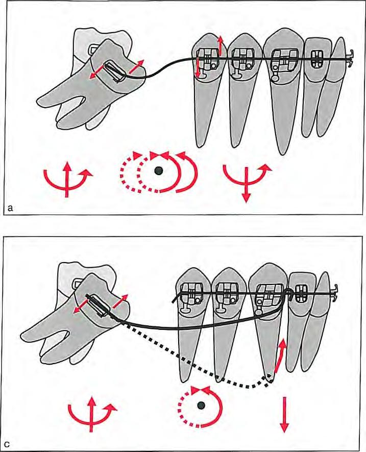8 I Correction of Anteroposterior Discrepancies Fig 8.9 If a flexible straight wire is engaged in the mesially tipped molar (a), the tooth uprights with extrusion.