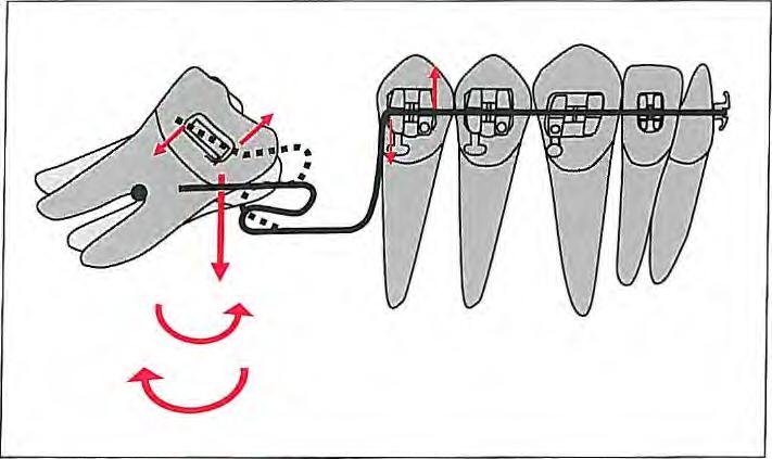 Fig 8-10 When uprighting molars with a looped archwire, some clinicians make incorrect steps in the loop to intrude the molar.