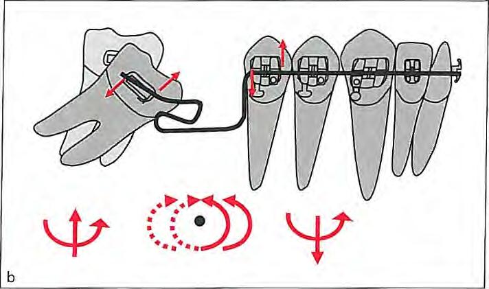 To avoid extrusion and clockwise rotation of the anterior segment and apply optimum intrusive force on the molar, the difference between moments should be as low as possible.