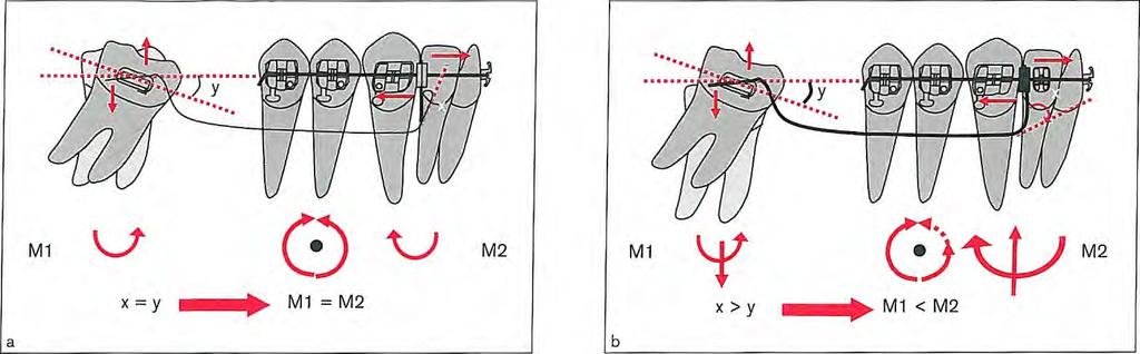 Uprighting Mesially Tipped Molars Fig 8-11 In high-angle cases, molar extrusion needs to be avoided during uprighting.